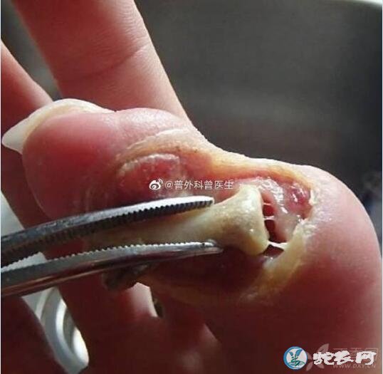 夢(mèng)見手指被蛇咬了_夢(mèng)見自己手指被蛇咬出血_夢(mèng)見蛇咬自己的手指