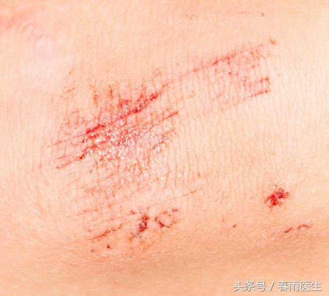 講真的，只是被狗蹭破了皮也要打狂犬疫苗嗎？｜十萬(wàn)個(gè)求生指南
